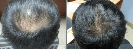 Sérum para el crecimiento y contra la caída del cabello