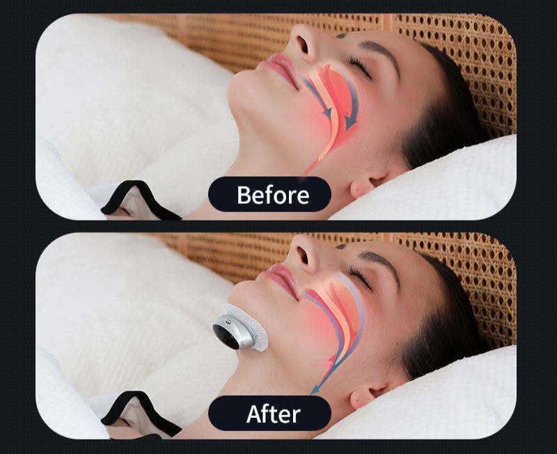 Bienelia™ Dispositivo inteligente para la apnea del sueño