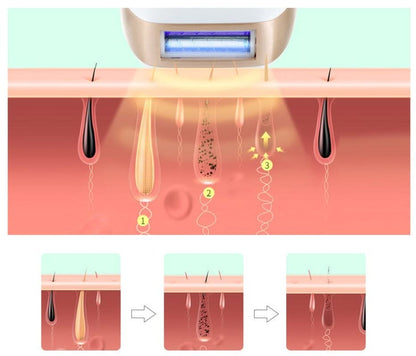 Bienelia™ Dispositivo de depilación láser IPL