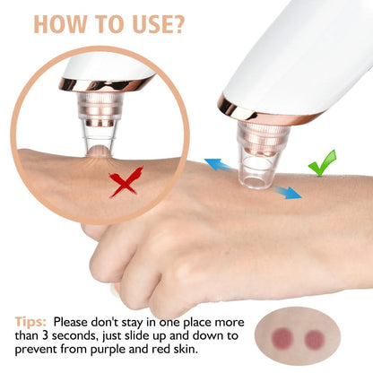Bienelia™ Aspirador de puntos negros
