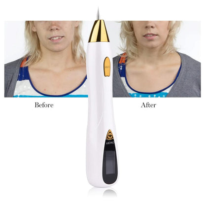 Bienelia™ Lápiz de plasma para eliminar lunares