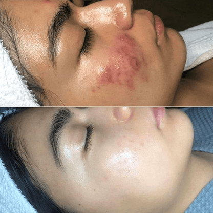 Bienelia™ Terapia cutánea de alta frecuencia